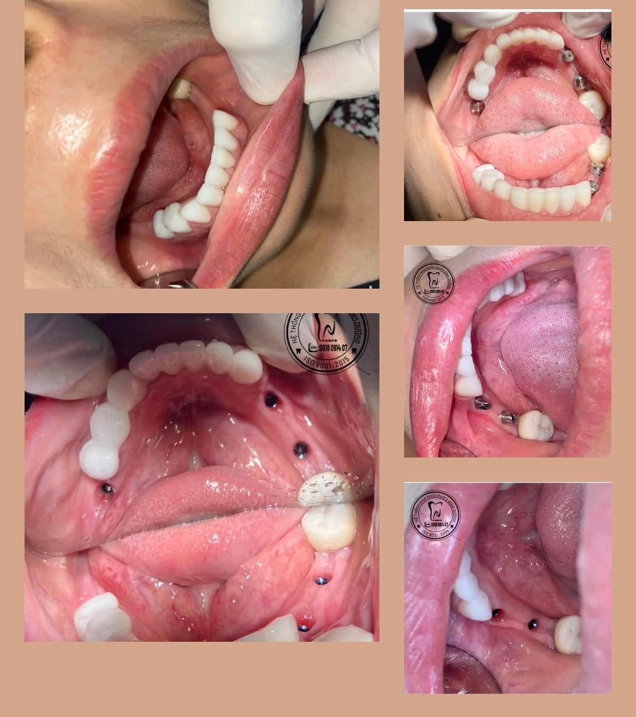 Ghep Xuong Implant