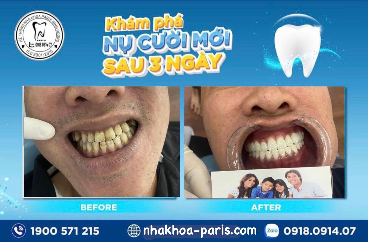 Nhung Truong Hop Khong Nen Boc Rang Su