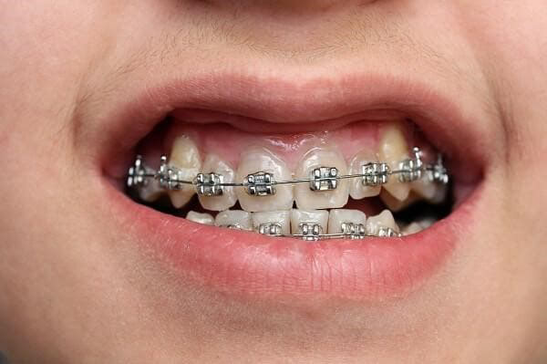 Niềng Răng Móm